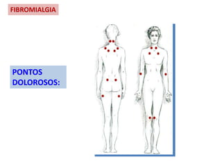 FIBROMIALGIA
PONTOS
DOLOROSOS:
 