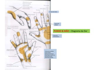 PUNHO & MÃO – Diagrama da Dor
Artrose dos dedos
Fratura de
falange
Fratura de
metacarpiano
Fratura de escafóide
Cisto sinovial
Doença de Kienbock
Dissociação escafolunar
Artrose de punho
Artrite Reumatóide
 