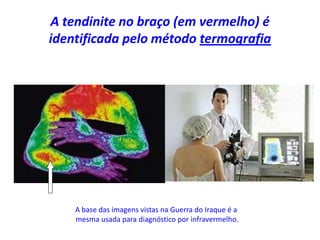 A tendinite no braço (em vermelho) é
identificada pelo método termografia
A base das imagens vistas na Guerra do Iraque é a
mesma usada para diagnóstico por infravermelho.
 