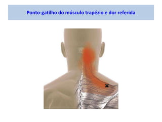 Ponto-gatilho do músculo trapézio e dor referida
 
