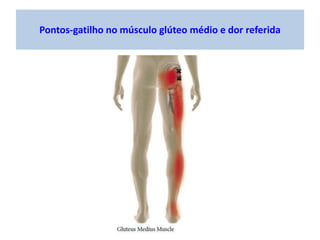 Pontos-gatilho no músculo glúteo médio e dor referida
 