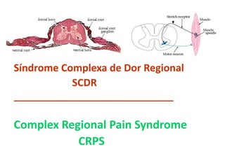 Síndrome Complexa de Dor Regional
SCDR
________________________________
Complex Regional Pain Syndrome
CRPS
 