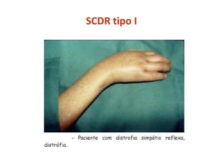 SCDR tipo I
 
