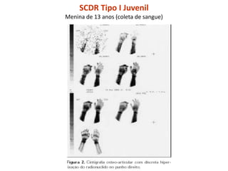 SCDR Tipo I Juvenil
Menina de 13 anos (coleta de sangue)
 