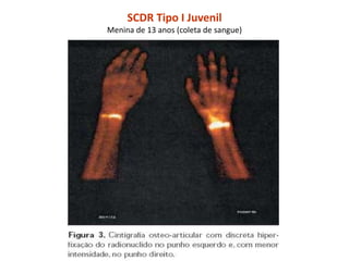 SCDR Tipo I Juvenil
Menina de 13 anos (coleta de sangue)
 