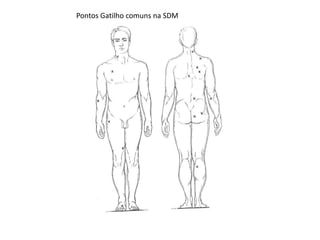 Pontos Gatilho comuns na SDM
 