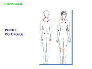 FIBROMIALGIA
PONTOS
DOLOROSOS:
 