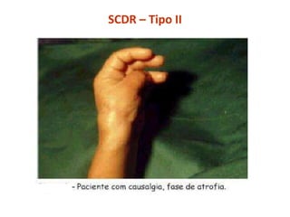 SCDR – Tipo II
 
