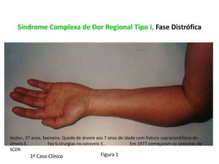 Síndrome Complexa de Dor Regional Tipo I, Fase Distrófica
Figura 1
Mulher, 37 anos, faxineira. Queda de árvore aos 7 anos de idade com fratura supracondiliana do
úmero E. Fez 6 cirurgias no cotovelo E.. Em 1977 começaram os sintomas de
SCDR.
1º Caso Clínico
 