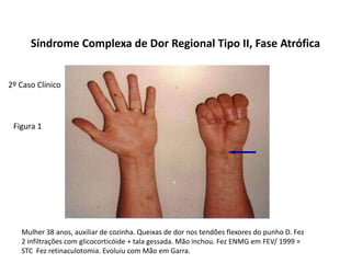 Síndrome Complexa de Dor Regional Tipo II, Fase Atrófica
Figura 1
Mulher 38 anos, auxiliar de cozinha. Queixas de dor nos tendões flexores do punho D. Fez
2 infiltrações com glicocorticóide + tala gessada. Mão inchou. Fez ENMG em FEV/ 1999 =
STC Fez retinaculotomia. Evoluiu com Mão em Garra.
2º Caso Clínico
 