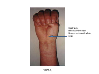 Figura 2
Cicatriz da
retinaculotomia dos
flexores sobre o túnel do
carpo
 