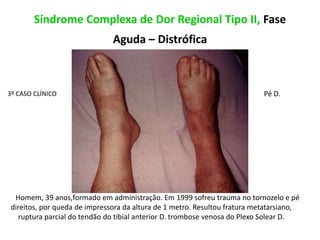 Síndrome Complexa de Dor Regional Tipo II, Fase
Aguda – Distrófica
3º CASO CLÍNICO
Homem, 39 anos,formado em administração. Em 1999 sofreu trauma no tornozelo e pé
direitos, por queda de impressora da altura de 1 metro. Resultou fratura metatarsiano,
ruptura parcial do tendão do tibial anterior D. trombose venosa do Plexo Solear D.
Pé D.
 