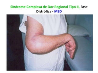 Síndrome Complexa de Dor Regional Tipo II, Fase
Distrófica - MSD
 