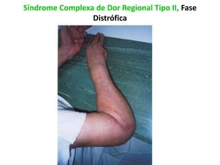 Síndrome Complexa de Dor Regional Tipo II, Fase
Distrófica
 