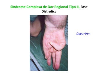 Síndrome Complexa de Dor Regional Tipo II, Fase
Distrófica
Dupuytren
 