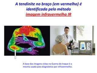 A tendinite no braço (em vermelho) é
identificada pelo método
imagem infravermelha IR
A base das imagens vistas na Guerra do Iraque é a
mesma usada para diagnóstico por infravermelho.
 