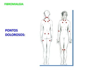 FIBROMIALGIA
PONTOS
DOLOROSOS:
 