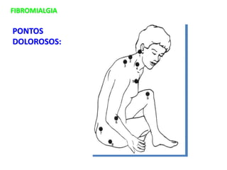 FIBROMIALGIA
PONTOS
DOLOROSOS:
 