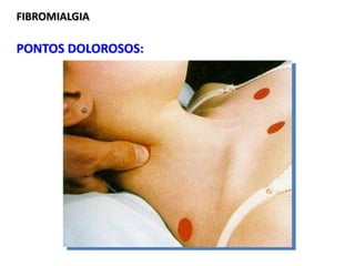 FIBROMIALGIA
PONTOS DOLOROSOS:
 