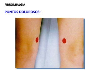 FIBROMIALGIA
PONTOS DOLOROSOS:
 