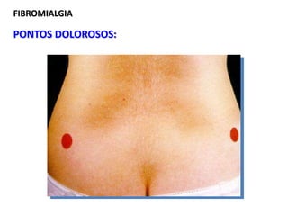 FIBROMIALGIA
PONTOS DOLOROSOS:
 