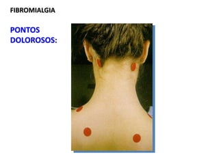 FIBROMIALGIA
PONTOS
DOLOROSOS:
 