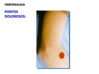 FIBROMIALGIA
PONTOS
DOLOROSOS:
 