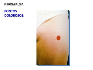 FIBROMIALGIA
PONTOS
DOLOROSOS:
 