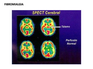 FIBROMIALGIAFIBROMIALGIA
 