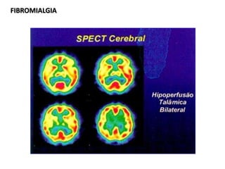 FIBROMIALGIAFIBROMIALGIA
 