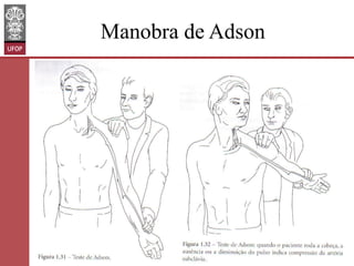 Manobra de Adson

www.otaviomelo.com.br

 