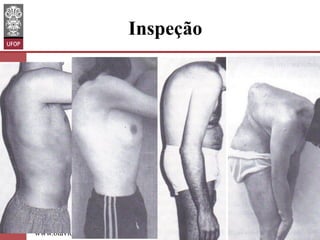 Inspeção
•  ( em pé):
–  Simetria do músculo
peitoral;
–  Projeção de um dos
seios : rotação das
costelas
•  Escoliose;

–  Deformidades da
parede;
www.otaviomelo.com.br

 