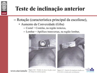 Teste de inclinação anterior
–  Rotação (característica principal da escoliose),
•  Aumento da Convexidade (Giba)
–  Costal = Costelas, na região torácica,
–  Lombar = Apófises transversas, na região lombar,

www.otaviomelo.com.br

 