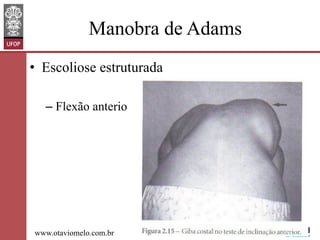 Manobra de Adams
•  Escoliose estruturada
–  Flexão anterio

www.otaviomelo.com.br

 