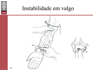 Instabilidade em valgo

www.otaviomelo.com.br

 
