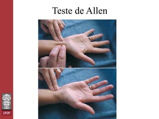 Teste de Allen

 