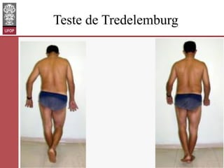 Teste de Tredelemburg

www.otaviomelo.com.br

 