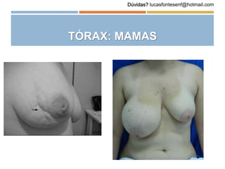 TÓRAX: MAMAS
Dúvidas? lucasfontesenf@hotmail.com
 