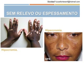 SEM RELEVO OU ESPESSAMENTO
Hipocromia.
Hipercromia.
Dúvidas? lucasfontesenf@hotmail.com
 