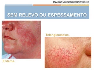SEM RELEVO OU ESPESSAMENTO
Eritema.
Telangiectasias.
Dúvidas? lucasfontesenf@hotmail.com
 