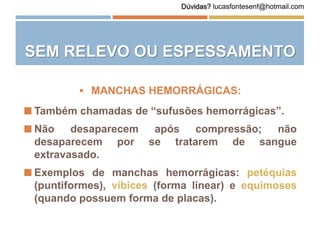  Também chamadas de “sufusões hemorrágicas”.
 Não desaparecem após compressão; não
desaparecem por se tratarem de sangue
extravasado.
 Exemplos de manchas hemorrágicas: petéquias
(puntiformes), víbices (forma linear) e equimoses
(quando possuem forma de placas).
 MANCHAS HEMORRÁGICAS:
SEM RELEVO OU ESPESSAMENTO
Dúvidas? lucasfontesenf@hotmail.com
 