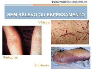 SEM RELEVO OU ESPESSAMENTO
Petéquias.
Víbices.
Equimose.
Dúvidas? lucasfontesenf@hotmail.com
 