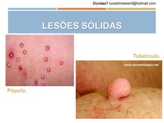 LESÕES SÓLIDAS
Pápula.
Tubérculo.
Dúvidas? lucasfontesenf@hotmail.com
 