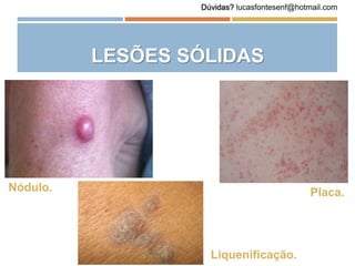 LESÕES SÓLIDAS
Nódulo. Placa.
Liquenificação.
Dúvidas? lucasfontesenf@hotmail.com
 