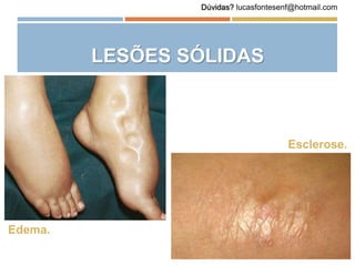 LESÕES SÓLIDAS
Edema.
Esclerose.
Dúvidas? lucasfontesenf@hotmail.com
 