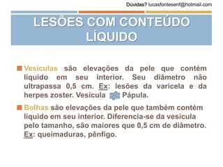 LESÕES COM CONTEÚDO
LÍQUIDO
 Vesículas são elevações da pele que contém
líquido em seu interior. Seu diâmetro não
ultrapassa 0,5 cm. Ex: lesões da varicela e da
herpes zoster. Vesícula Pápula.
 Bolhas são elevações da pele que também contém
líquido em seu interior. Diferencia-se da vesícula
pelo tamanho, são maiores que 0,5 cm de diâmetro.
Ex: queimaduras, pênfigo.
Dúvidas? lucasfontesenf@hotmail.com
 