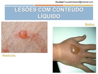 LESÕES COM CONTEÚDO
LÍQUIDO
Vesícula.
Bolha.
Dúvidas? lucasfontesenf@hotmail.com
 