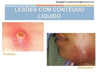 LESÕES COM CONTEÚDO
LÍQUIDO
Pústula.
Abscesso.
Dúvidas? lucasfontesenf@hotmail.com
 