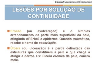 LESÕES POR SOLUÇÃO DE
CONTINUIDADE
 Erosão (ou exulceração) é o simples
arranchamento da parte mais superficial da pele,
atingindo APENAS a epiderme. Quando traumática,
recebe o nome de escoriação.
 Úlcera (ou ulceração) é a perda delimitada das
estruturas que constituem a pele e que chega a
atingir a derme. Ex: úlcera crônica da pele, cancro
mole.
Dúvidas? lucasfontesenf@hotmail.com
 