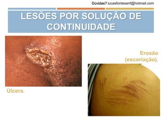 LESÕES POR SOLUÇÃO DE
CONTINUIDADE
Úlcera.
Erosão
(escoriação).
Dúvidas? lucasfontesenf@hotmail.com
 
